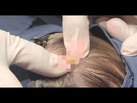 Woman’s huge cyst on scalp gets popped as pus squirts out like ‘cheese ravioli’