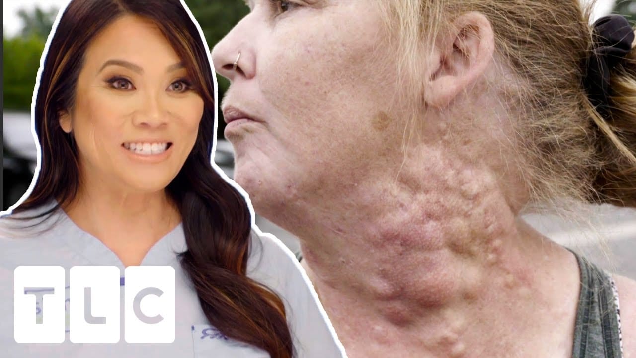 Woman’s Medication Makes Bumps Grow All Over Her Neck | Dr. Pimple Popper