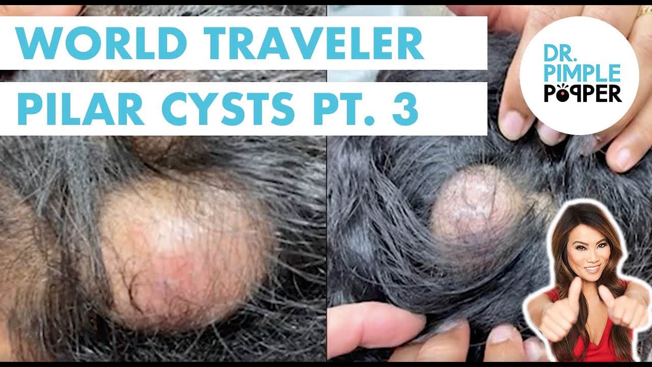World Traveler Pilar Cyst Part 3