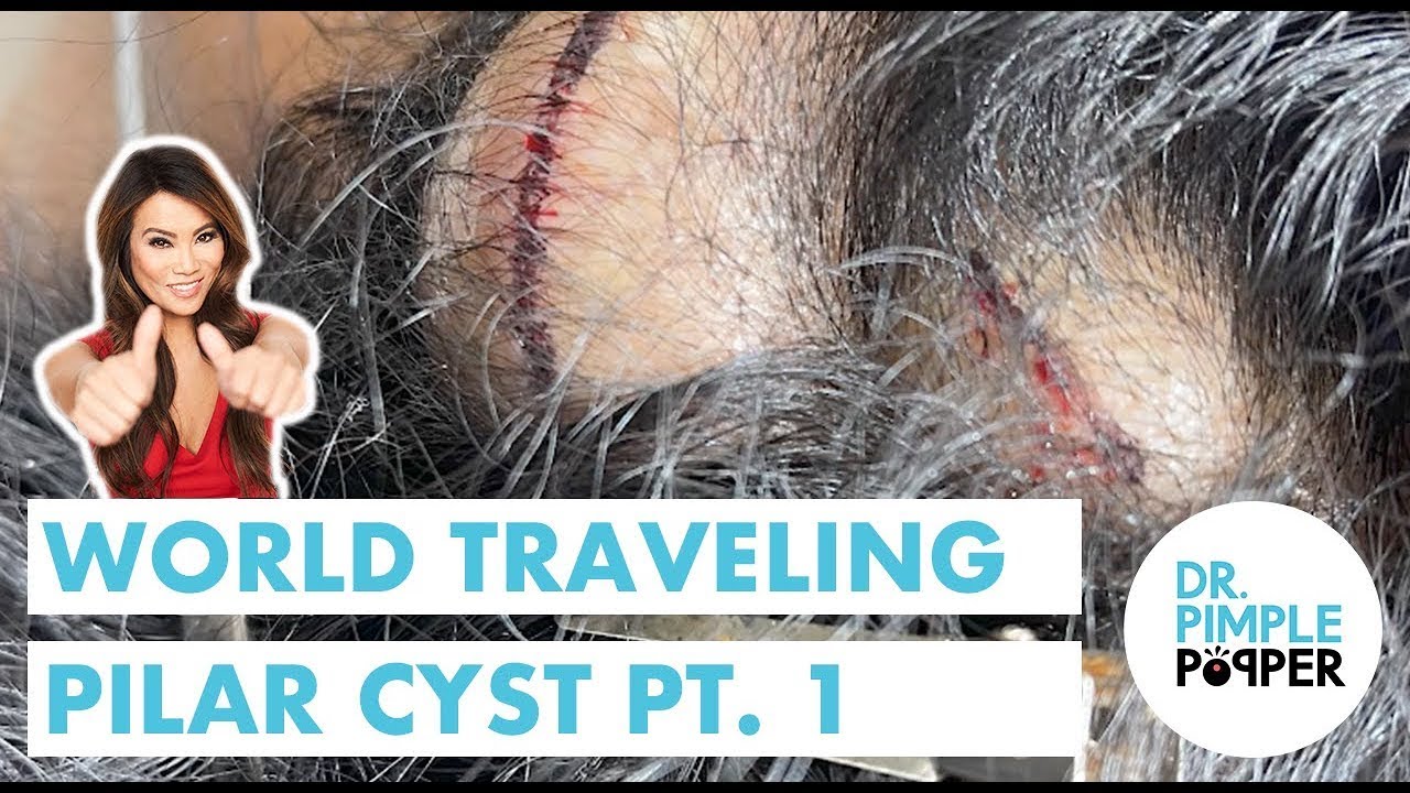 World Traveling Pilar Cyst Part 1