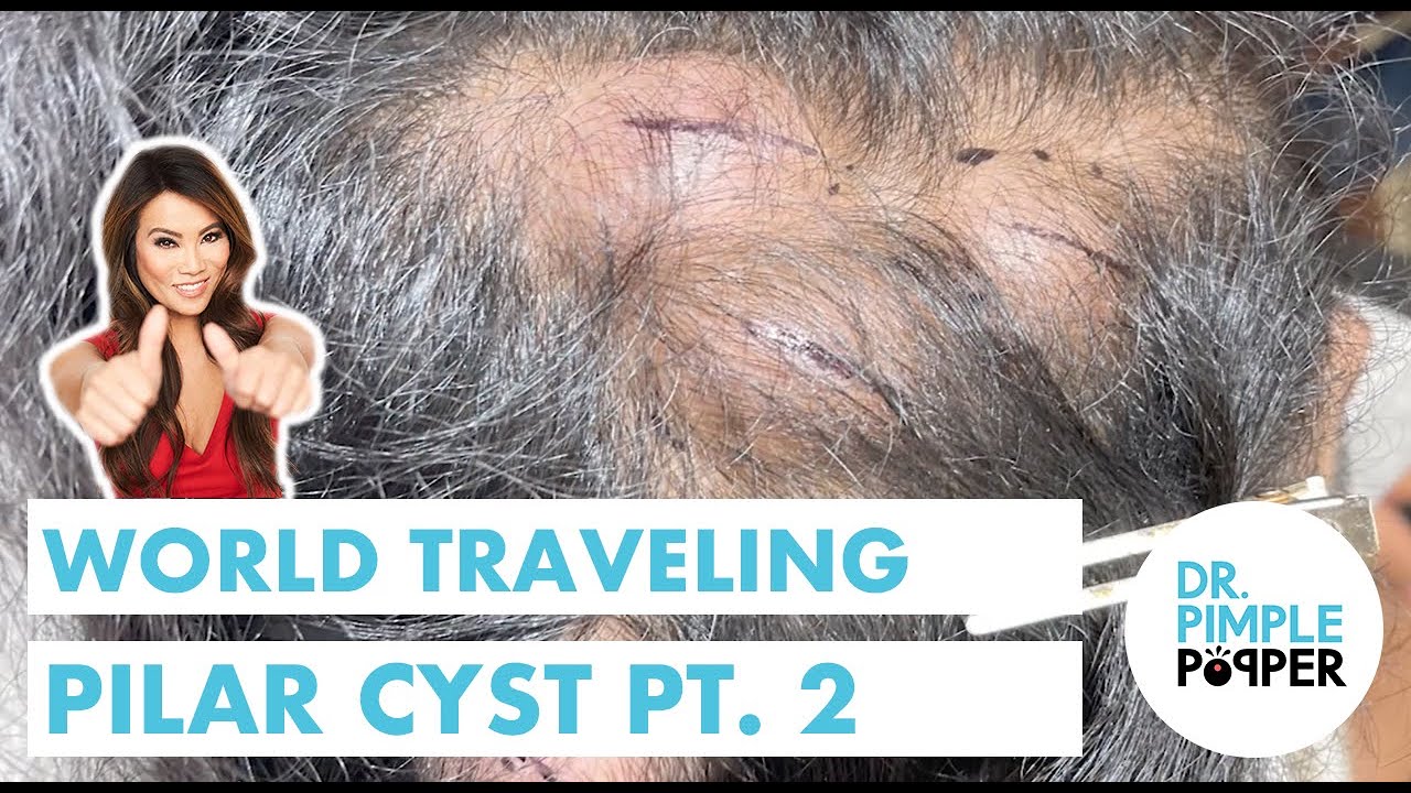 World Traveling Pilar Cyst: Part 2