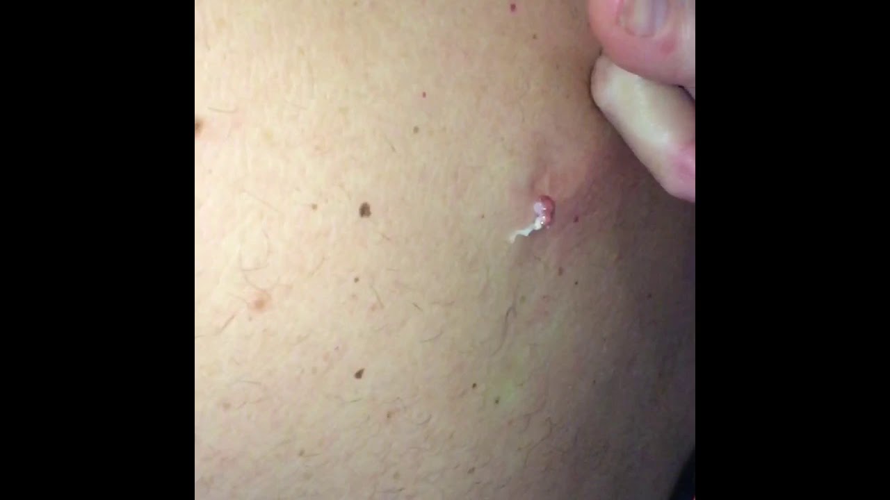 WORLDS BEST PIMPLE POPPING