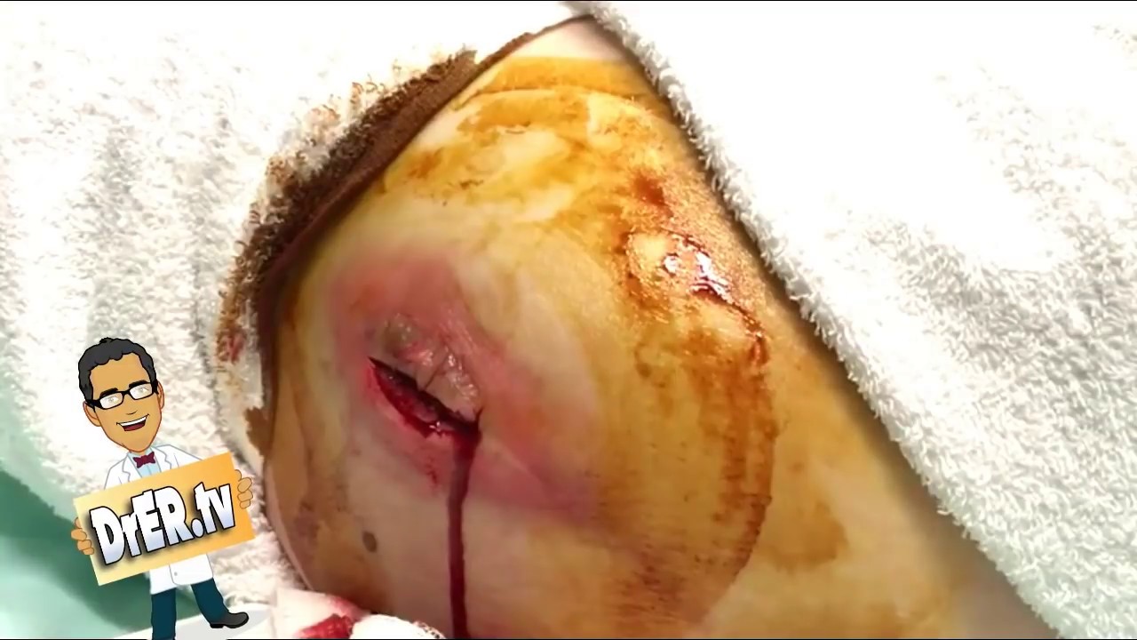 World’s Largest Abscess, Cyst Popping? What is it?