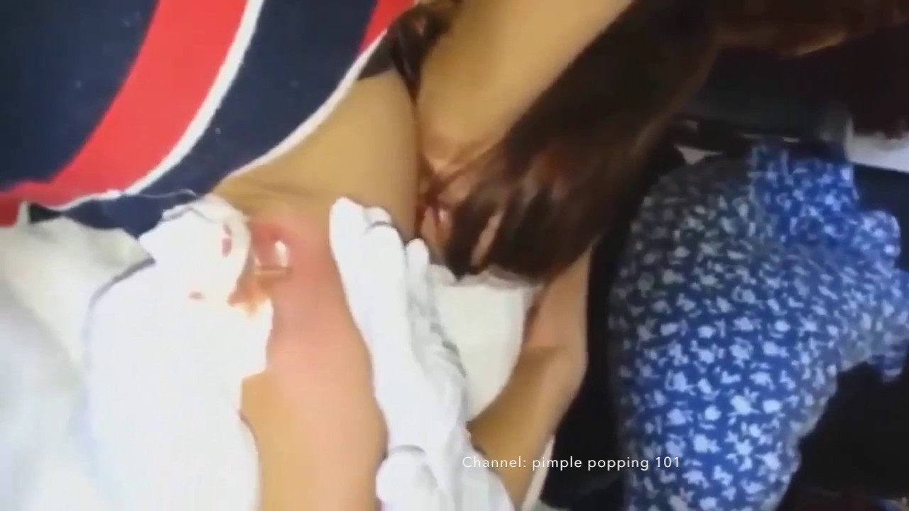 Worlds largest armpit cyst of 2016. Graphic pimple popping