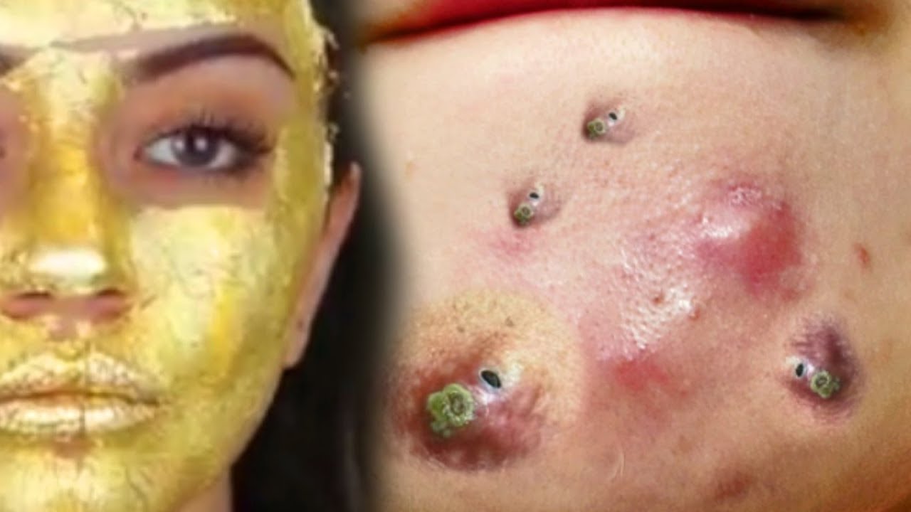 World’s Largest Face Cysts (Amateur Popping) and Gold Mask for Holiday Gifts