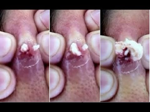 World's Largest Face Cysts (Amateur Popping) and Gold Mask for Holiday Gifts Amazing Getting Rid