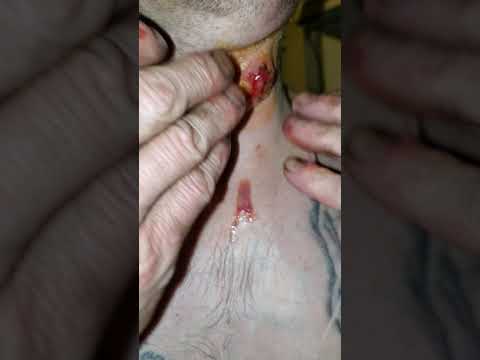 WORLD'S Most epic & SATISFYING pimple pop!! HANDS DOWN!!! WATCH TO END AMAZING CORE EXPLOSION!!