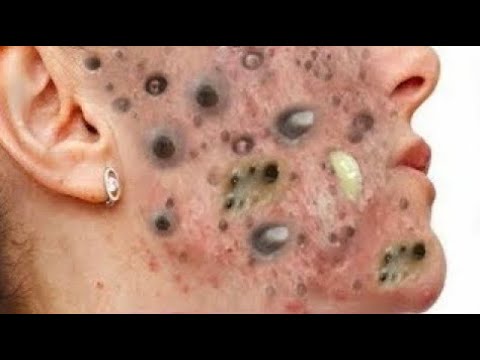 Worlds Worst Trypophobia; What is Trypophobia Cysts, Acne, Makeup, Pimples #13 • 2021