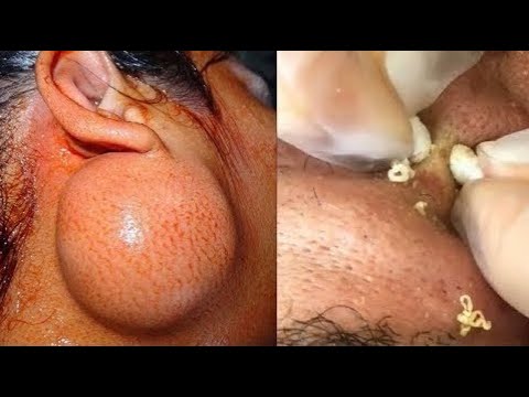 Worlds Worst Trypophobia; What is Trypophobia Cysts, Acne, Makeup, Pimples #10 • 2021