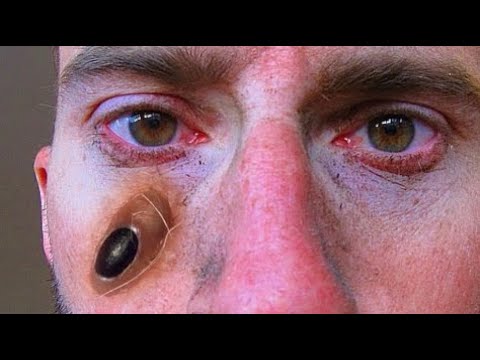 Worlds Worst Trypophobia; What is Trypophobia Cysts, Acne, Makeup, Pimples #31 • 2021