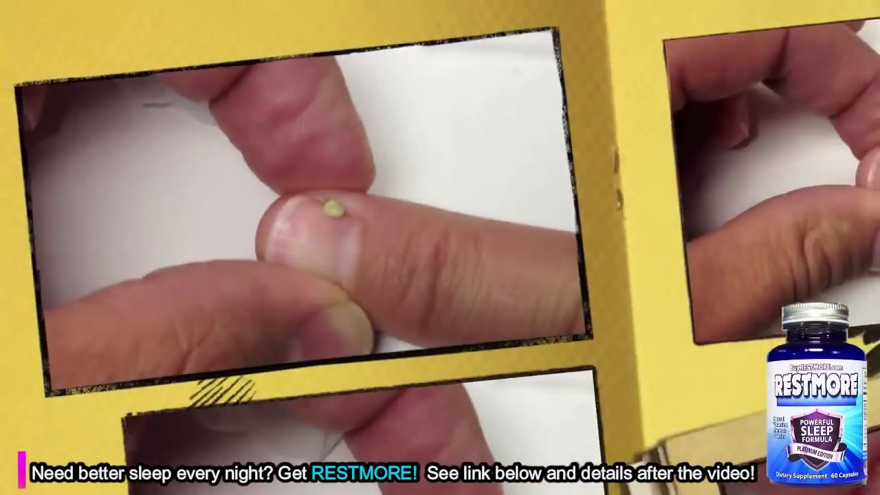 Worst Finger Infections and Paronychia on YouTube!  Cyst Bustin’ Saturday