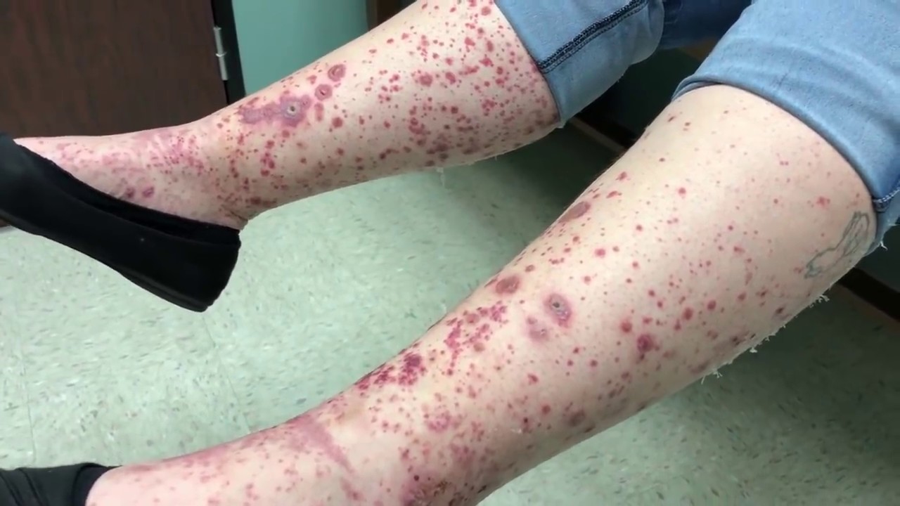 Worst Infected Leg Pimples!  Cyst, Boil, Lesions or Whiteheads?