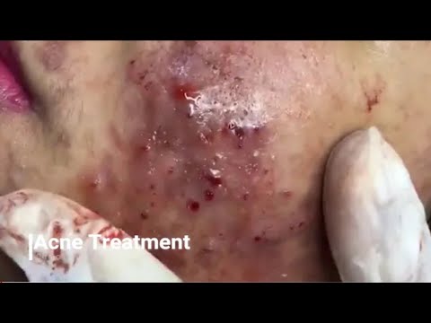 WORST REMOVAL BLACKHEADS PIMPLE POPPING ACNE REMOVAL