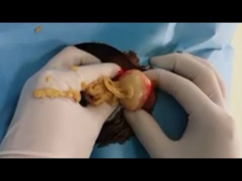 Worst Scalp Cysts, Head Cysts & Pilar Cyst Popping ??????