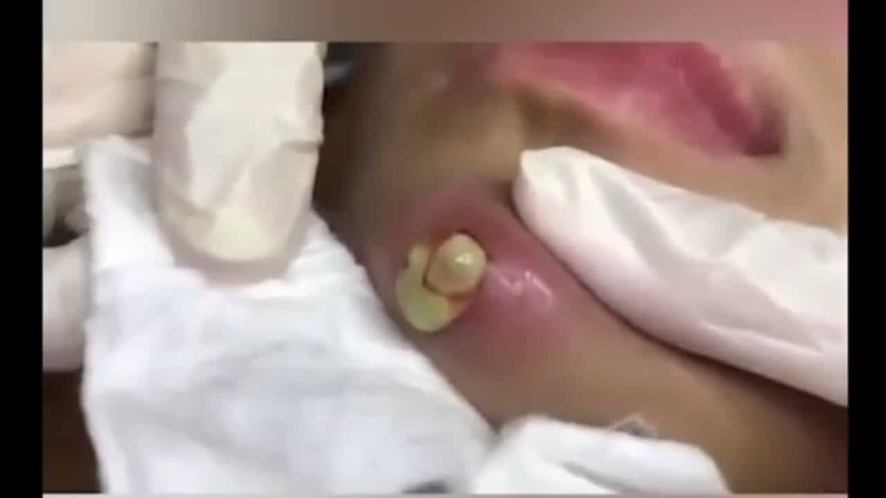 Wow Big pimple popping removal on face-Acne removal