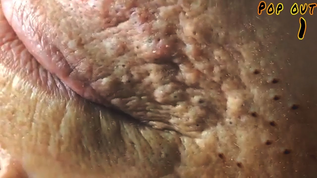WOW very big blackheads on old men face and near mouth part1