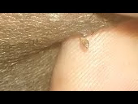 WRIGGLING it's way out – Pimple Popper #pimple #popping