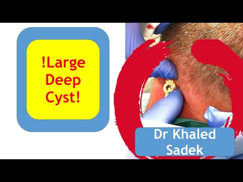 x2 Cyst Removed. Dr Khaled Sadek. London Cyst Clinic.