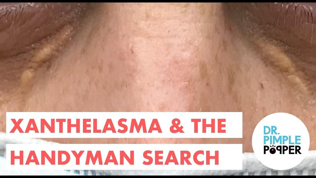 Xanthelasma & the Search for a Handy Man
