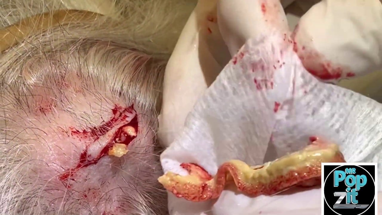 Yellow Eel Cyst. Huge Pilar cyst. Juicy cyst pop with full excision and closure.Cyst sac dissection