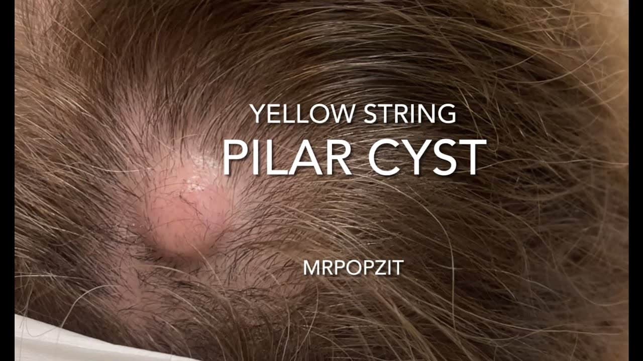 Yellow string Pilar Cyst. Firm cyst on scalp causing hair loss. Yellow pasty contents. MrPopZit