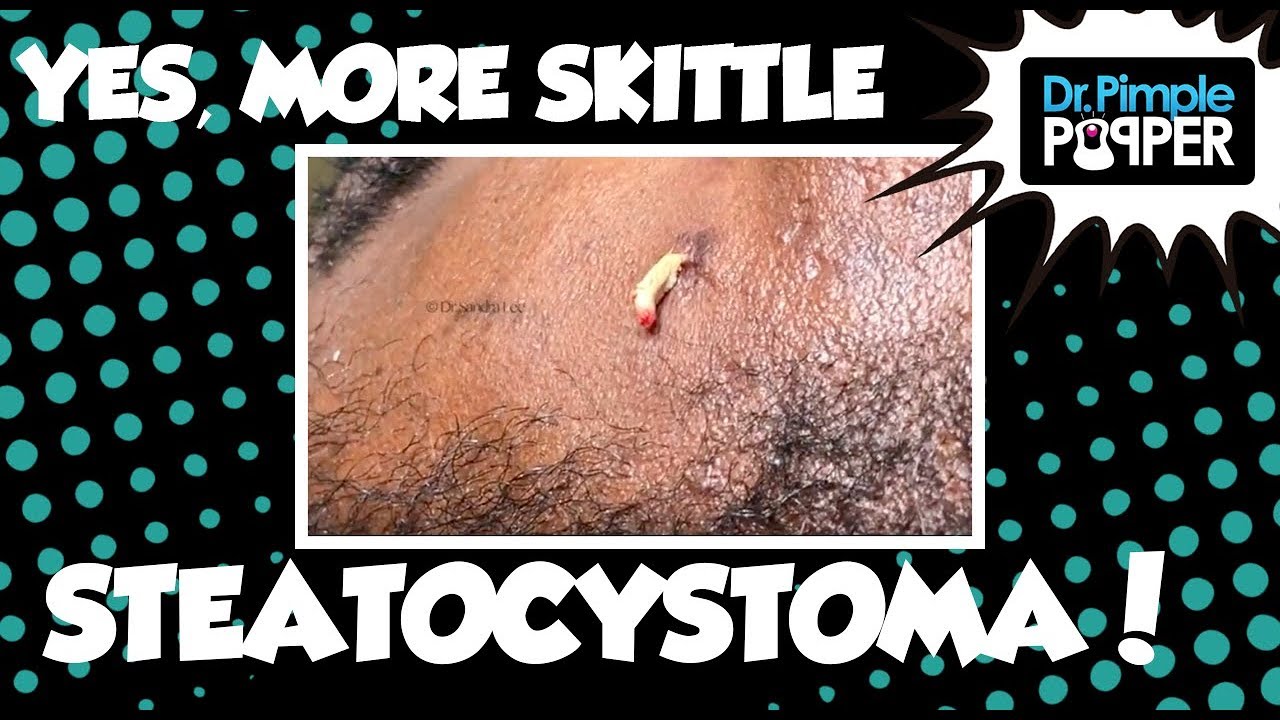 YES, More Skittle Steatocystoma – Session 6