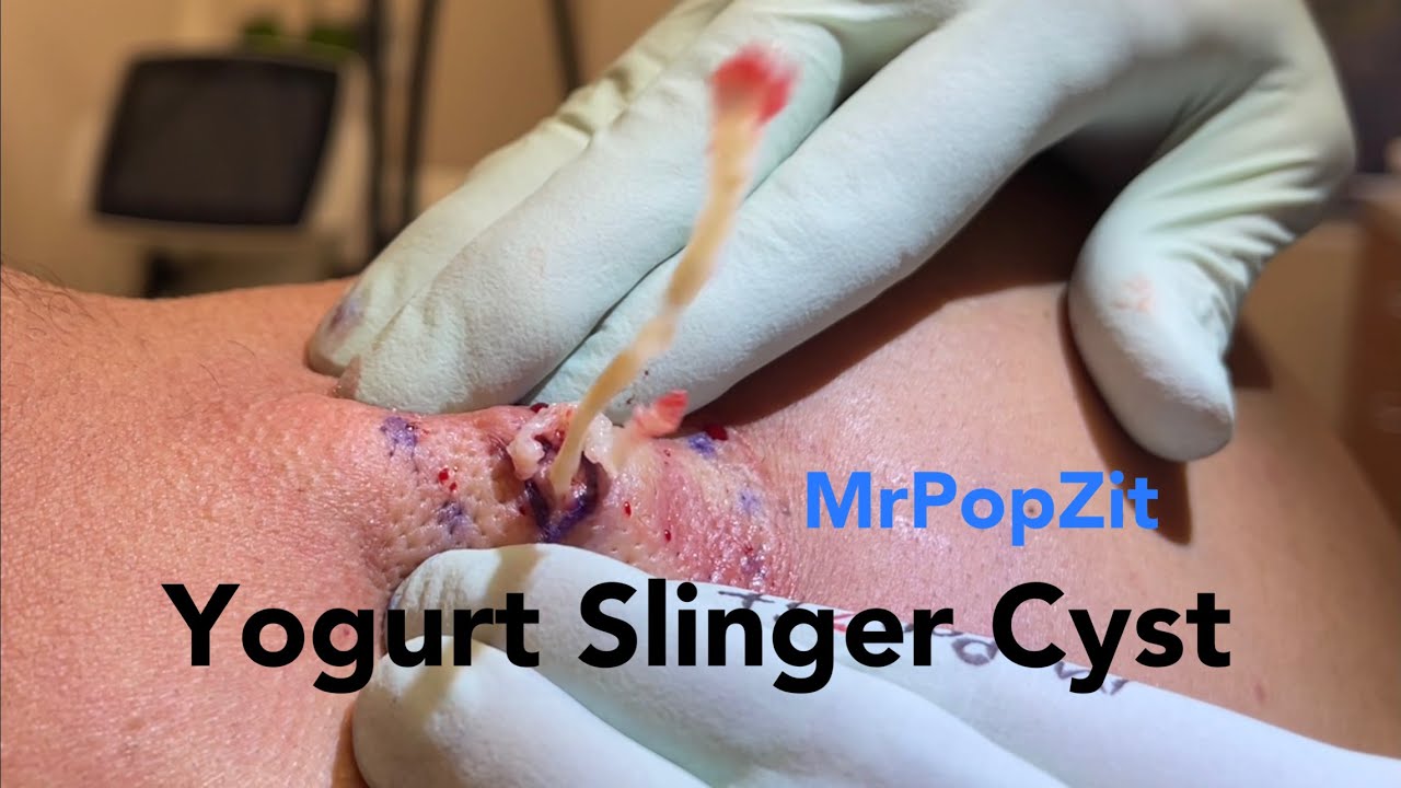 Yogurt Slinger Cyst.Cyst pops 6 feet to the floor! This video has it all, excision, pop, dissection
