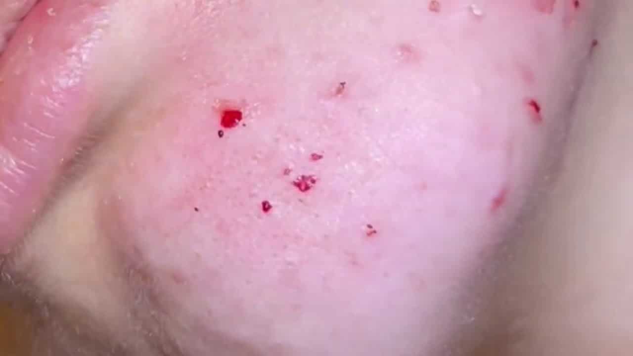 Your new fave extractions #5. Blackheads, whiteheads, ear extractions, pimple popping. Over 100 pops