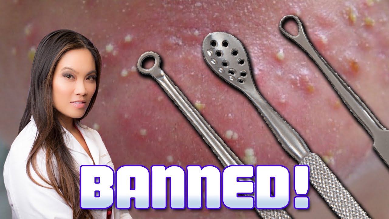 YouTube Vs Dr. Sandra Lee, Pimple Popping, Zits & Blackhead Removal