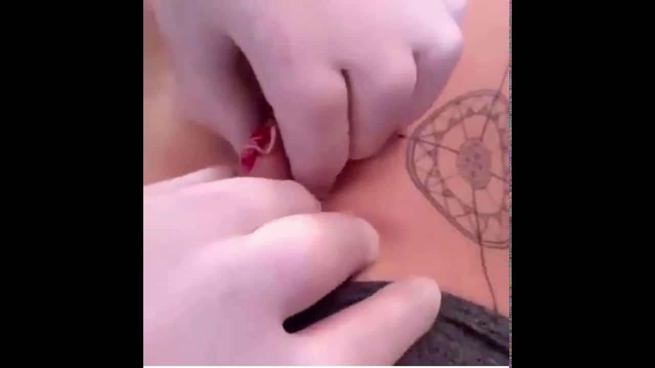 Zit, cyst, popper. Pimple popping