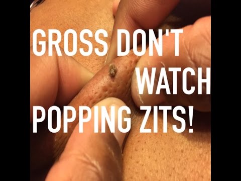 Zit Popping: AWESOME Mother’s Day Gift