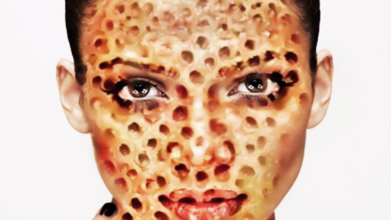 Zit Popping & Blackheads! Why Do People Love It? (Trypophobia)