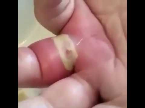 Zit popping cyst popping