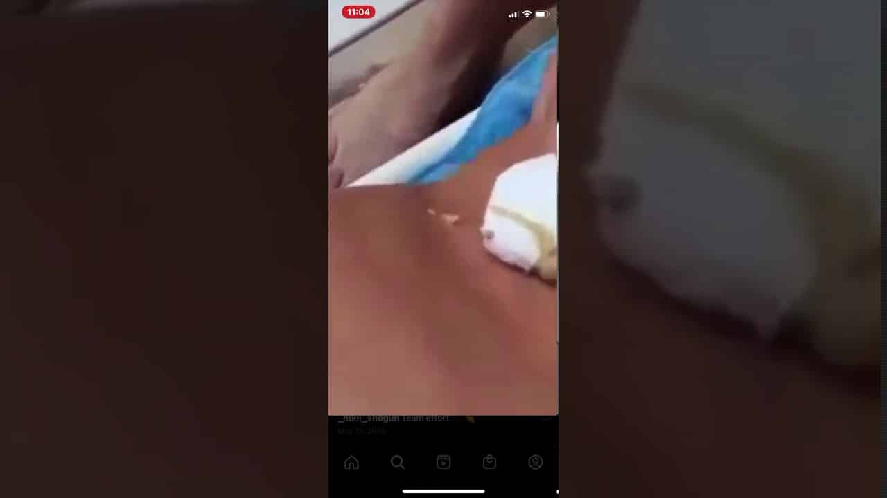 Zit popping Squirter. Cyst popper