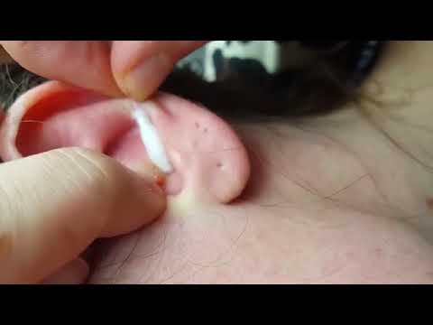 Zit Popping videos or Blackheads are the best Slow- Pimple Popping Lovers