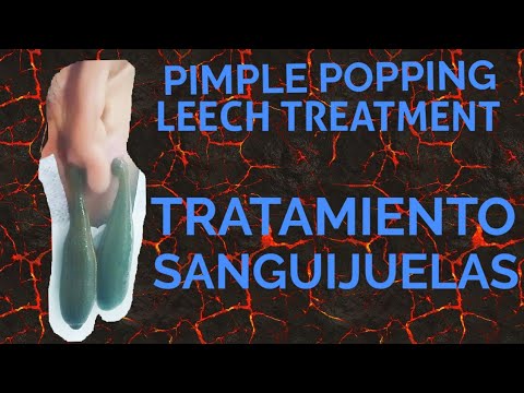 Zits pop, pimple popper, blackheads, remove toxins, cyst  Extractions, leech therapy, abscees