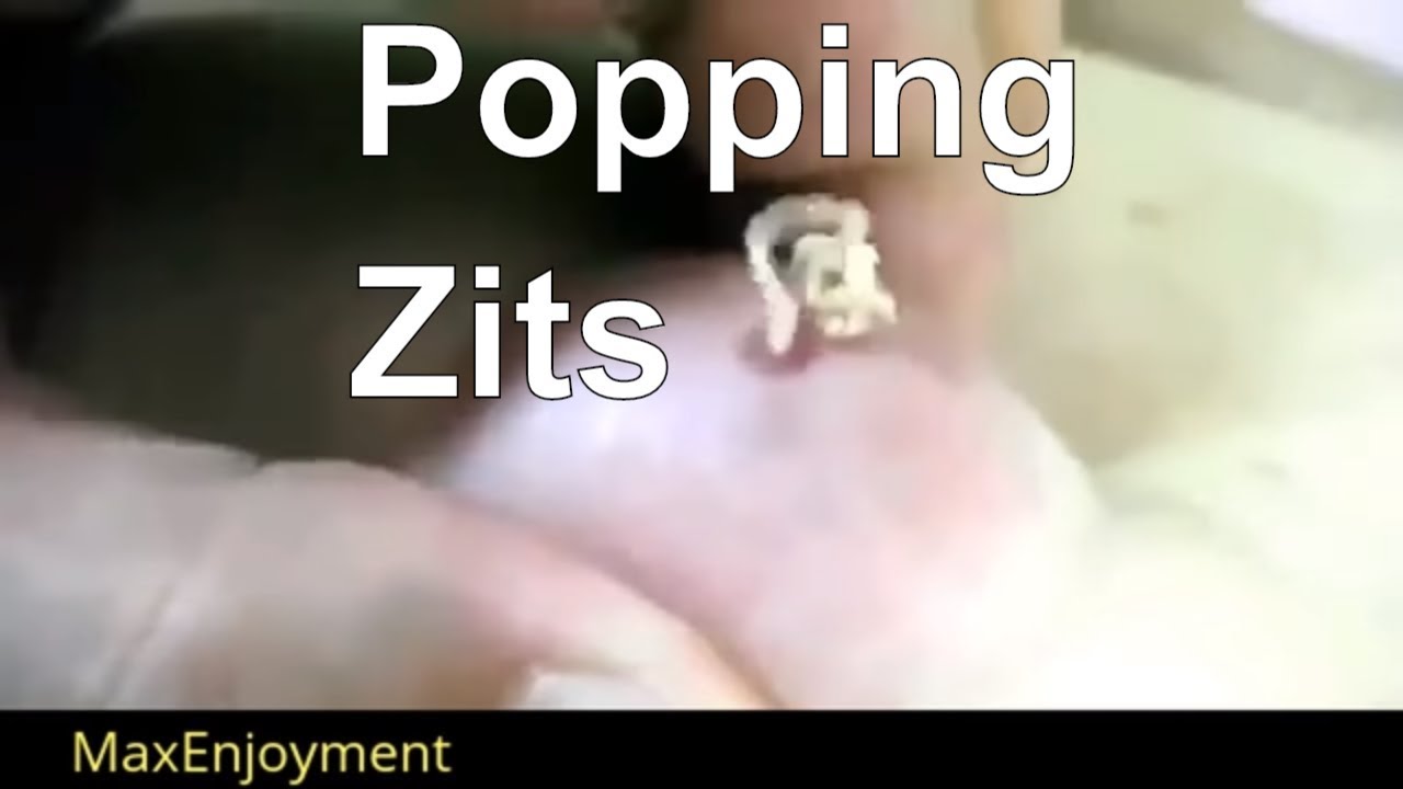 Zits Popping compilation: Try not to look away