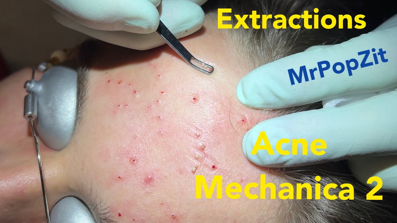 Acne Mechanica 2, blackhead extractions. Clearing keratin plugs from