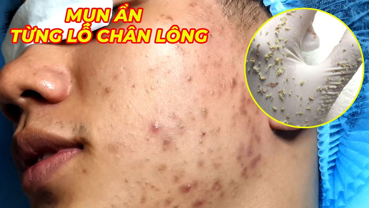 Loan Nguyen Acne Treatment #366 - Pimple Popping Videos