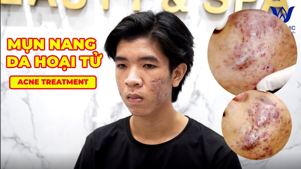 Loan Nguyen Acne Treatment #316 - Pimple Popping Videos