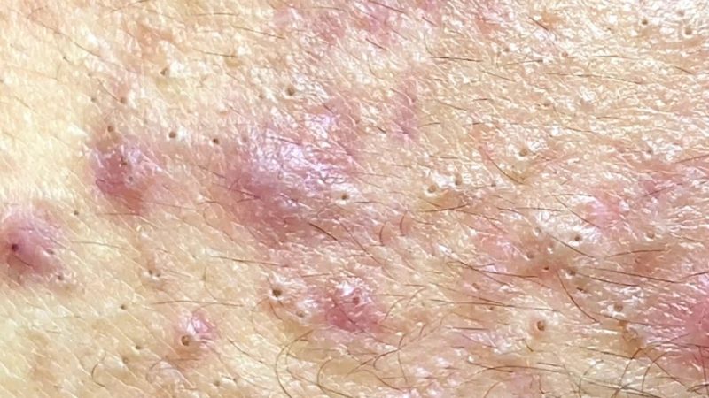 Intertrigo Rash In Skin Folds Causes Symptoms And Treatment Dr