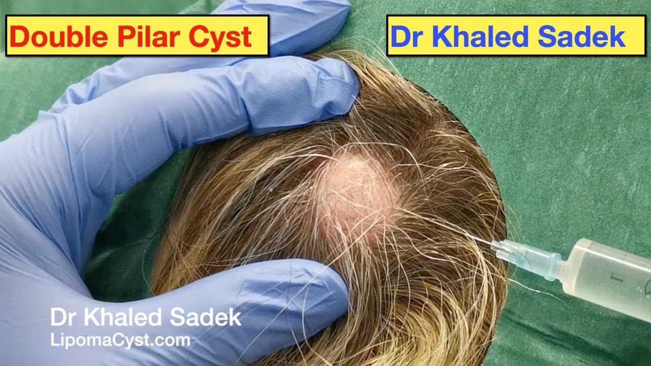 Massive Pilar Cysts Removed Dr Khaled Sadek Pimple