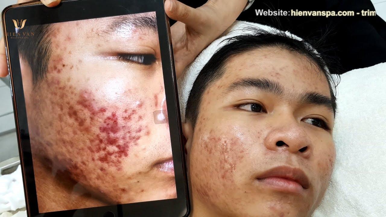 Female hormonal acne. Pimple popping extractions with 5 day follow up