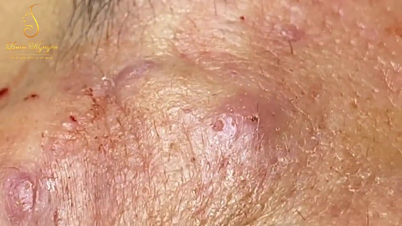 Blackheds And Whiteheads Extraction 284 Loan Nguyen Pimple Popping Videos