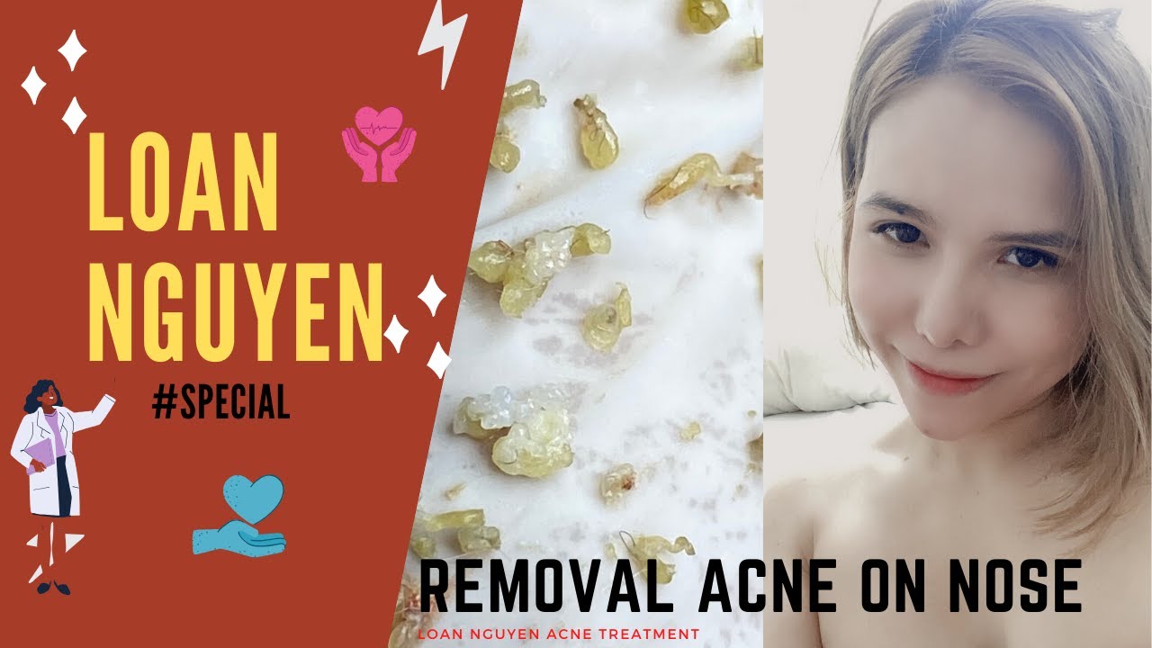 Specially remove BLACKHEADS on NOSE Loan Nguyen Pimple Popping Videos