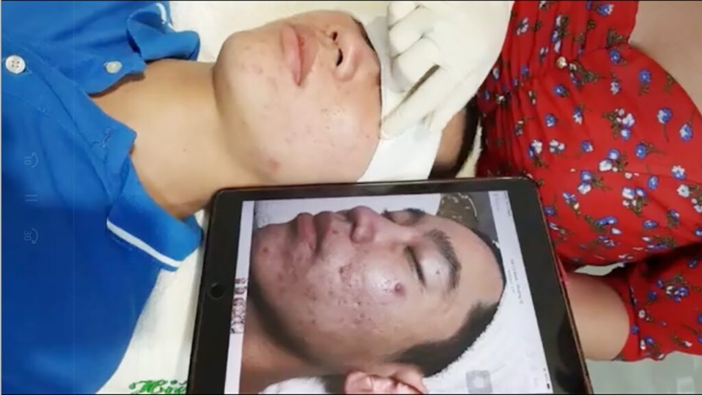 hulk-vs-the-abscess-infected-spider-bite-pimple-popping-videos