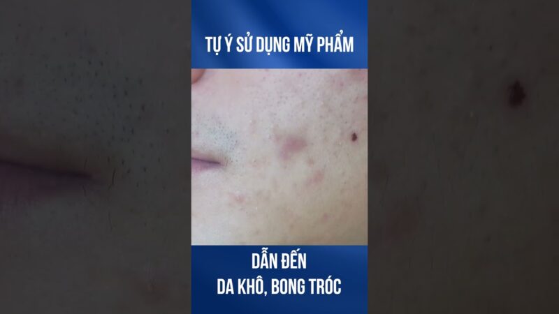 How To Identify What Type Of Acne Scars You Have #scout - Pimple ...