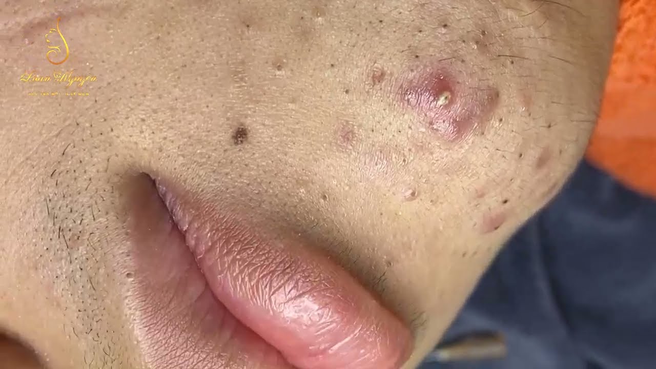 Loan Nguyen Acne Treatment 0538hn Pimple Popping Videos