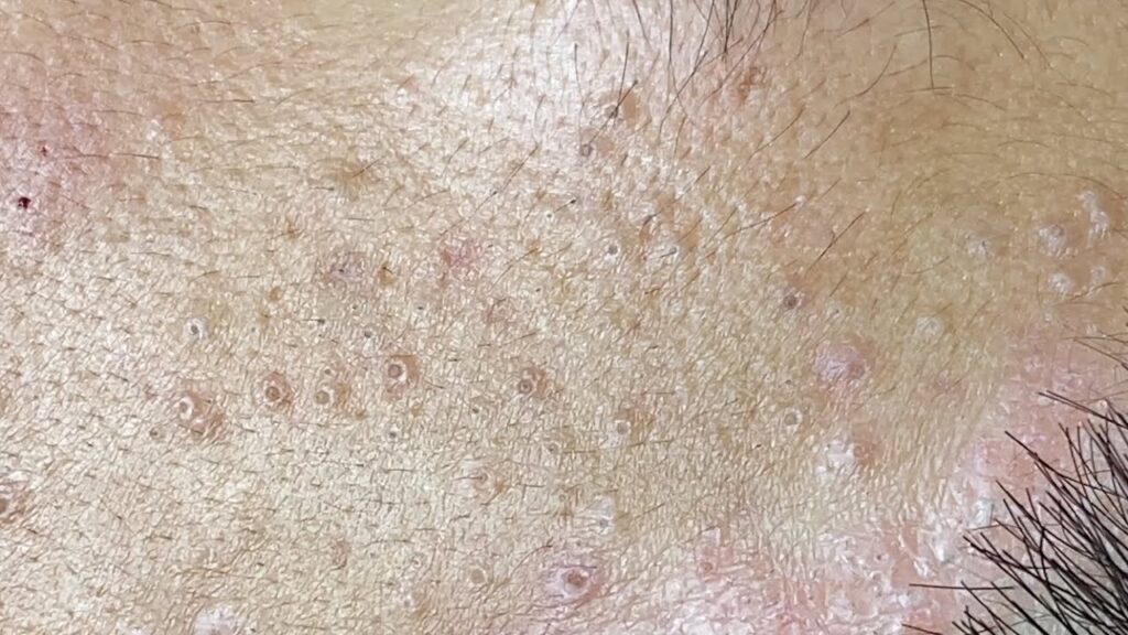 how to get rid of small pimples on shoulders
